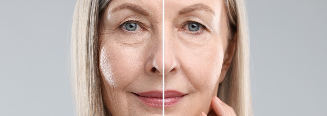 Rejuvenecimiento facial antes y después